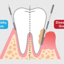 Severe Gum Disease