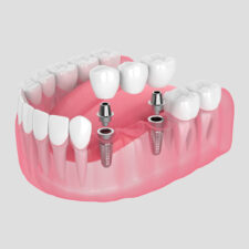 What is the Best Dental Treatment for Missing Teeth?
