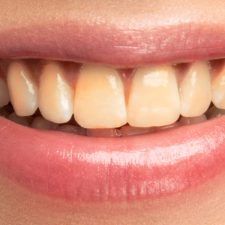 Tired of Yellow Teeth? Anthem Dental – Temecula Has the Solution