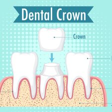 Say Goodbye to Gummy Smiles with Dental Crown Lengthening