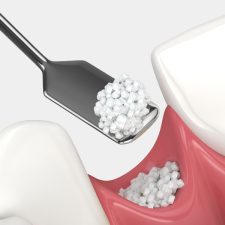 The Significance of Getting Bone Graft in Dental Implant Procedures