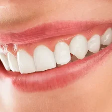 Tips for Maintaining Your Bonded Teeth for a Beautiful Smile