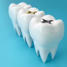 What Are Composite Fillings and Why Are They Important?