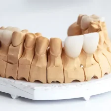 How to Choose the Right Shade for Porcelain Veneers